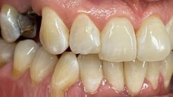 Are dental implants considered cosmetic bagi banyak orang
